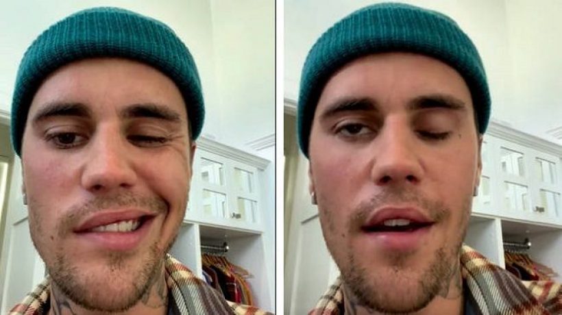 All to Know About Ramsay Hunt Syndrome Paralyzing One Side of Justin Bieber’s Face